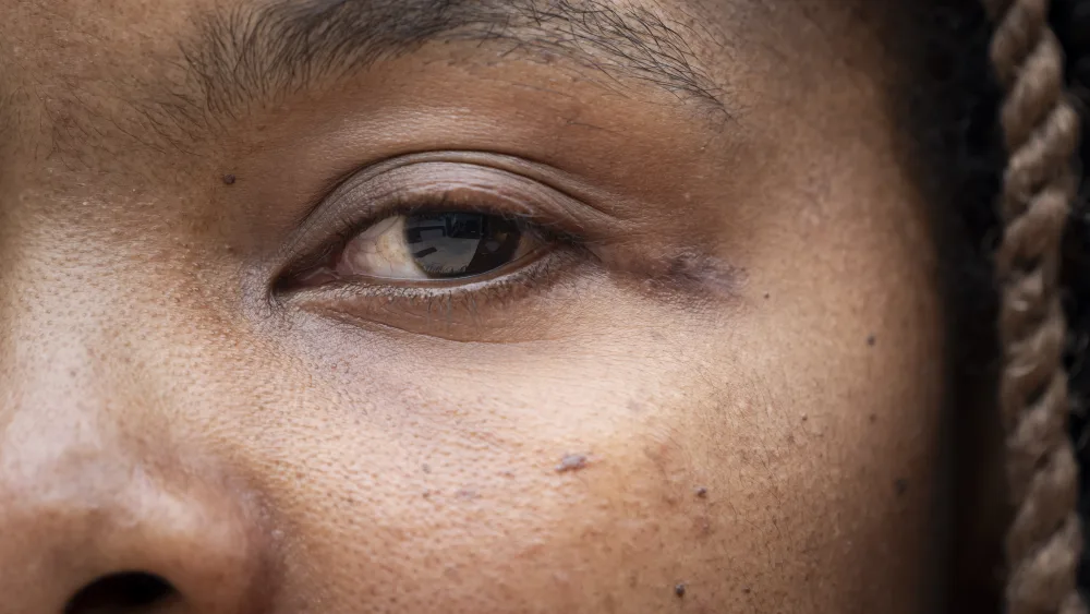 A new treatment has been approve for patients with advanced uveal melanoma – a rare type of eye cancer. (Danny Lawson/PA)