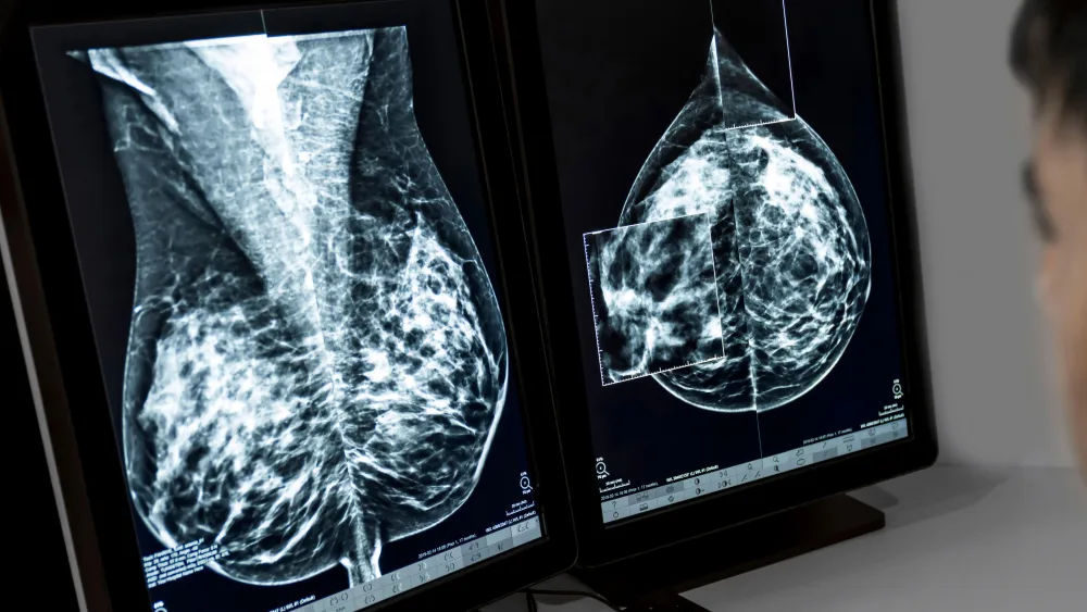 View of a breast scan on screens