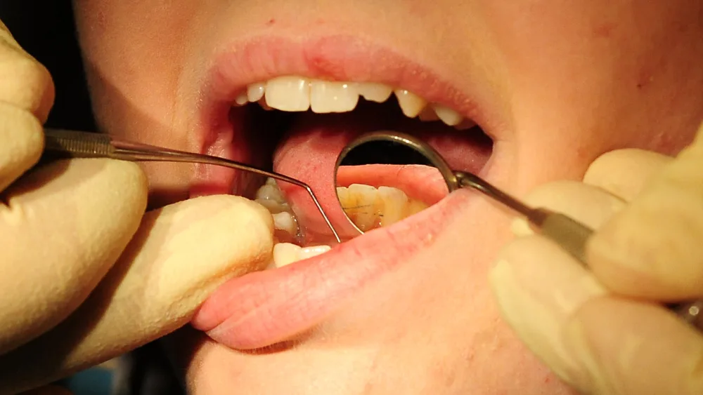 A dentist uses a mirror to look into a patient's mouth